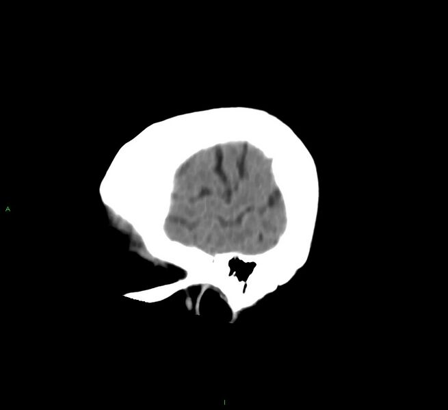 File:Cerebral amyloid angiopathy-associated lobar intracerebral hemorrhage (Radiopaedia 58757-65978 C 8).jpg