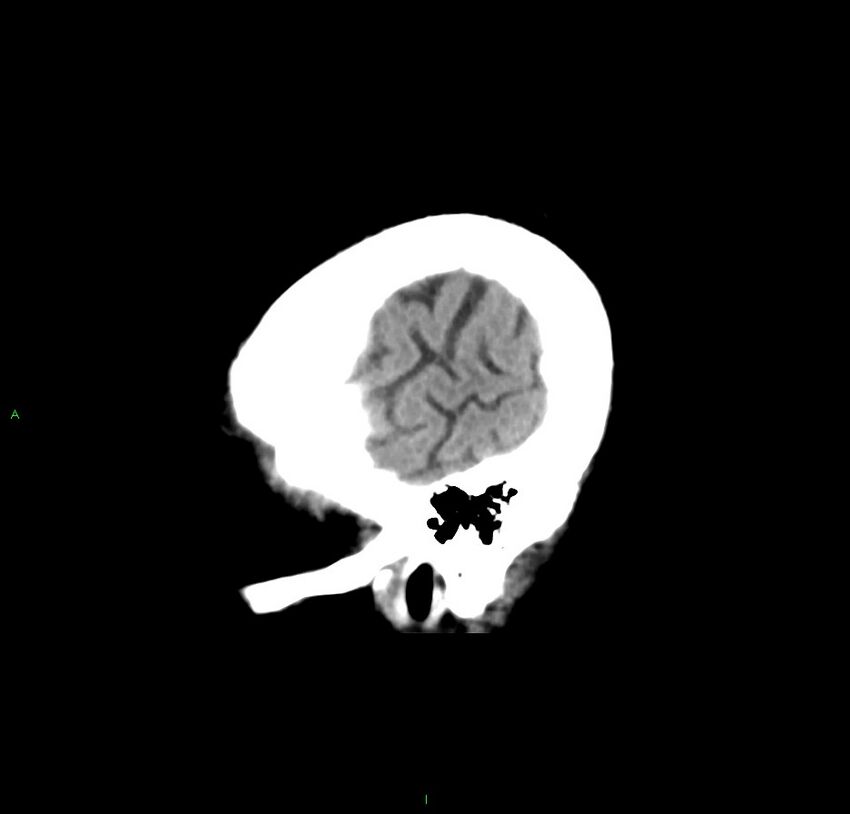Cerebral amyloid angiopathy-associated lobar intracerebral hemorrhage (Radiopaedia 59356-66716 C 48).jpg