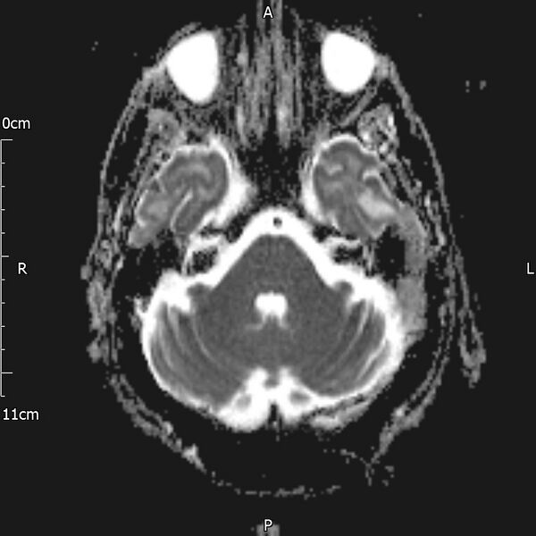 File:Cerebral amyloid angiopathy related inflammation (Radiopaedia 72772-83415 Axial ADC 7).jpg