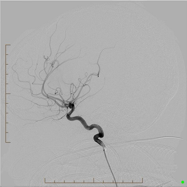 File:Cerebral arteriovenous malformation (AVM) (Radiopaedia 78162-90707 B 6).jpg