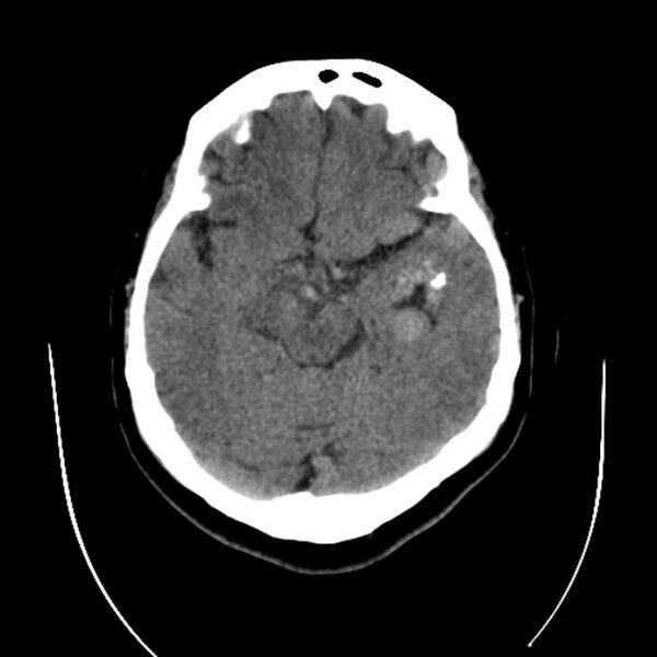 File:Cerebral arteriovenous malformation (Radiopaedia 43729-47189 Axial non-contrast 15).jpg