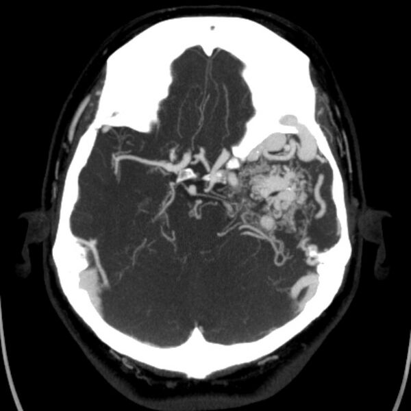 File:Cerebral arteriovenous malformation (Radiopaedia 43729-47189 B 17).jpg