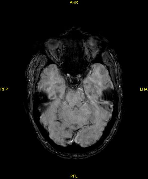 File:Cerebral autosomal dominant arteriopathy with subcortical infarcts and leukoencephalopathy (CADASIL) (Radiopaedia 86108-102054 Axial SWI 39).jpg