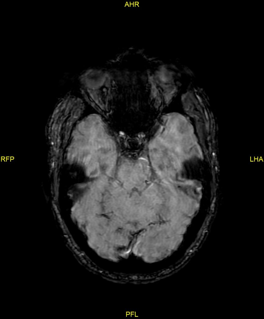 Cerebral autosomal dominant arteriopathy with subcortical infarcts and leukoencephalopathy (CADASIL) (Radiopaedia 86108-102054 Axial SWI 39).jpg