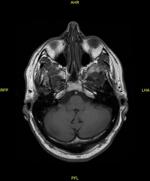 File:Cerebral autosomal dominant arteriopathy with subcortical infarcts and leukoencephalopathy (CADASIL) (Radiopaedia 86108-102054 Axial T1 7).jpg