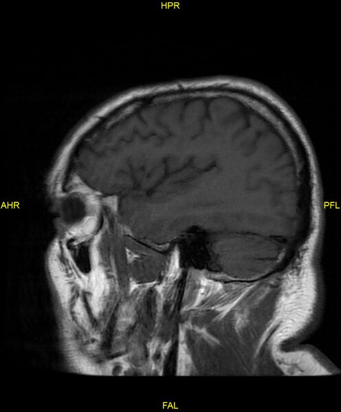 File:Cerebral autosomal dominant arteriopathy with subcortical infarcts and leukoencephalopathy (CADASIL) (Radiopaedia 86108-102054 Sagittal T1 7).jpg