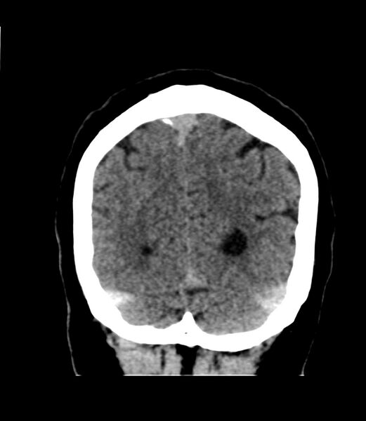 File:Cerebral dural venous sinus thrombosis (Radiopaedia 86514-102575 Coronal non-contrast 45).jpg