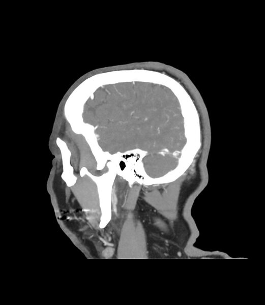 File:Cerebral dural venous sinus thrombosis (Radiopaedia 86514-102576 C 4).jpg
