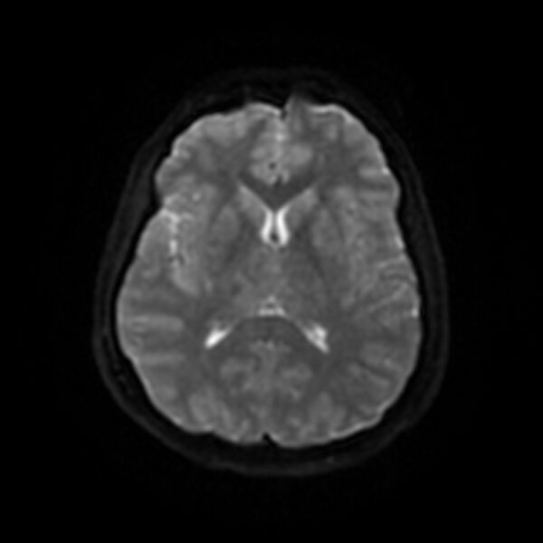 File:Cerebral fat embolism (Radiopaedia 37510-39363 Axial DWI 38).jpg