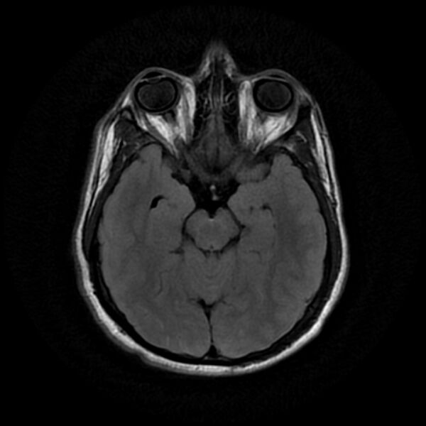 File:Cerebral fat embolism (Radiopaedia 37510-39363 Axial FLAIR 11).jpg