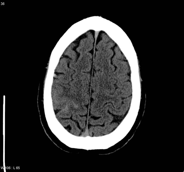 File:Cerebral vein thrombosis (Radiopaedia 4408-6628 Axial non-contrast 3).jpg