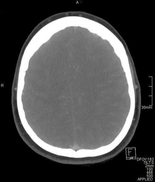 File:Cerebral venous sinus thrombosis (Radiopaedia 91329-108965 Axial venogram 60).jpg