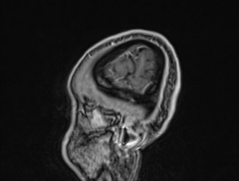 File:Cerebral venous thrombosis (Radiopaedia 71207-81504 Sagittal T1 C+ 61).jpg