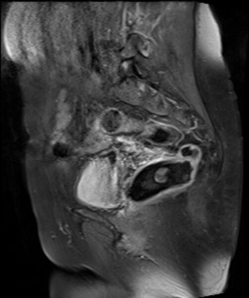 File:Cervical carcinoma (Radiopaedia 88312-104943 E 12).jpg