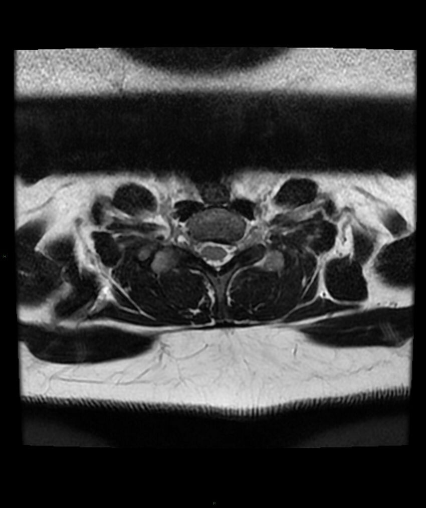 Cervical disc prolapse (Radiopaedia 80258-93598 Axial T2 70).jpg