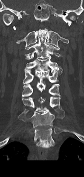 File:Cervical spine fracture - chalk stick (Radiopaedia 39116-41323 Coronal bone window 22).png