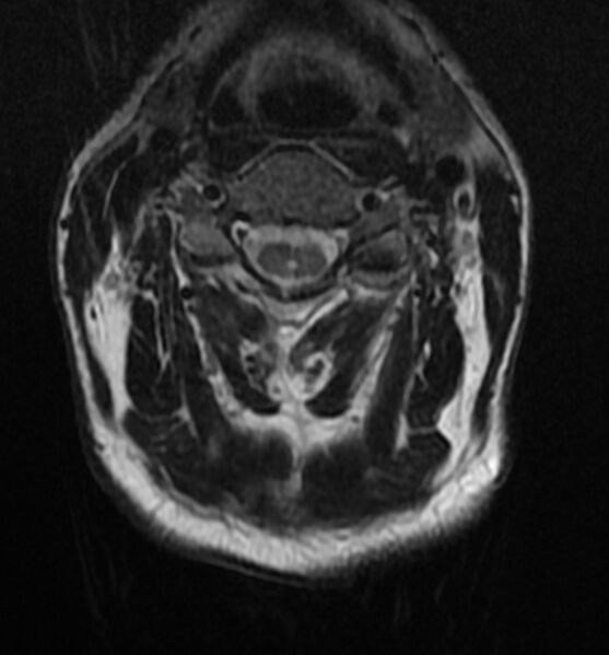File:Cervical spondylodiscitis (Radiopaedia 81362-95110 Axial T2 6).jpg