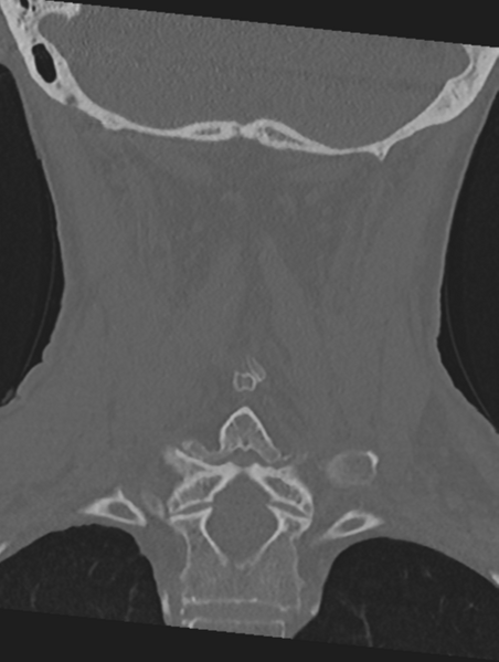 File:Cervical spondylolysis (Radiopaedia 49616-54811 Coronal bone window 40).png
