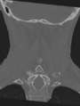 Cervical spondylolysis (Radiopaedia 49616-54811 Coronal bone window 40).png