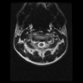 Cervical vertebrae metastasis (Radiopaedia 78814-91667 Axial T2 22).png