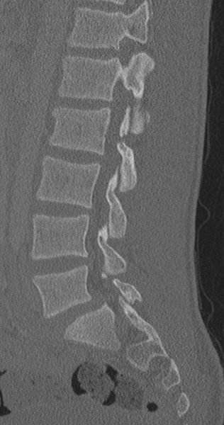 File:Chance fracture (Radiopaedia 40360-42912 Sagittal bone window 44).png