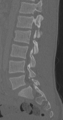 Chance fracture (Radiopaedia 40360-42912 Sagittal bone window 44).png