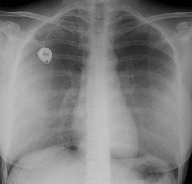 File:Chest port on chest x-ray (Radiopaedia 26966-27143 Frontal 1).png
