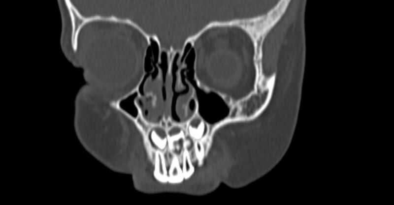 File:Choanal atresia (Radiopaedia 51295-56972 Coronal bone window 13).jpg
