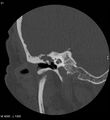 Cholesteatoma (Radiopaedia 5467-7197 Coronal bone window 6).jpg