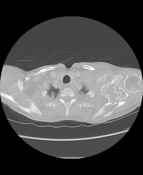File:Chondrosarcoma (Radiopaedia 79427-92532 Axial lung window 5).jpg