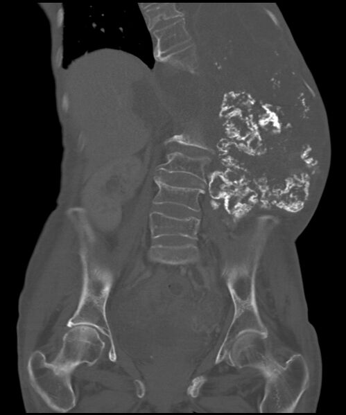 File:Chondrosarcoma of the spine (Radiopaedia 49871-55143 Coronal bone window 14).jpg