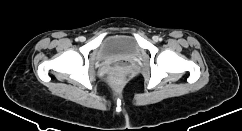 File:Choriocarcinoma liver metastases (Radiopaedia 74768-85766 A 199).jpg