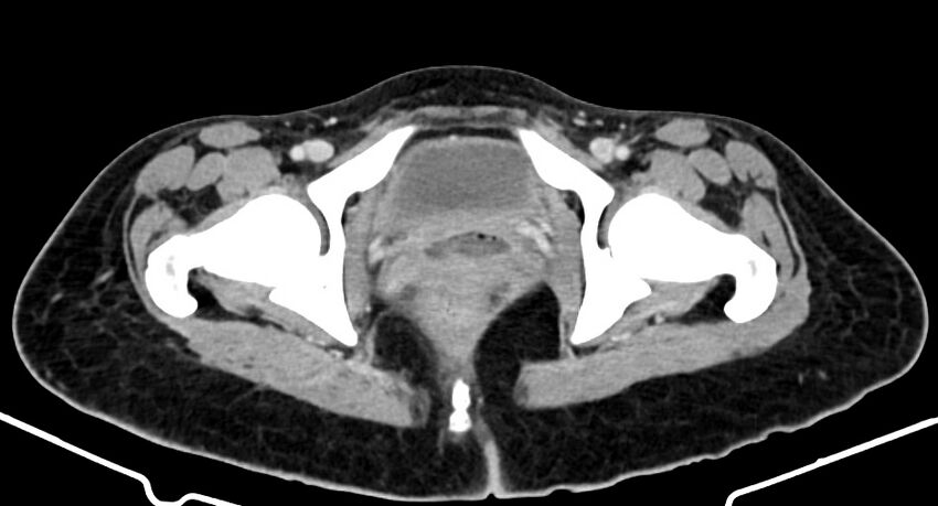 Choriocarcinoma liver metastases (Radiopaedia 74768-85766 A 199).jpg