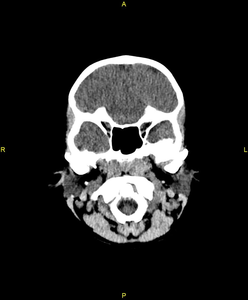 Choroidal fissure cyst (Radiopaedia 89481-106465 Axial non-contrast 23).jpg