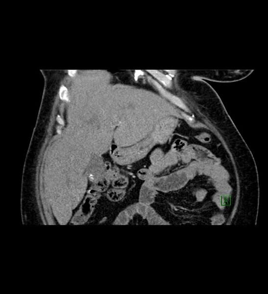 File:Chromophobe renal cell carcinoma (Radiopaedia 84239-99519 C 26).jpg