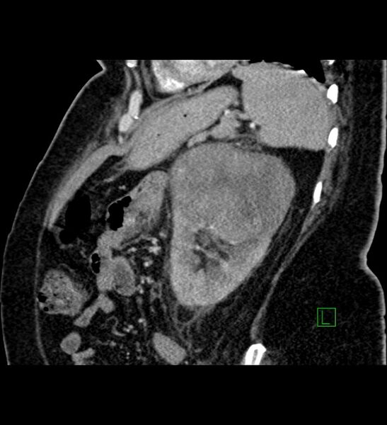 File:Chromophobe renal cell carcinoma (Radiopaedia 84239-99519 D 34).jpg