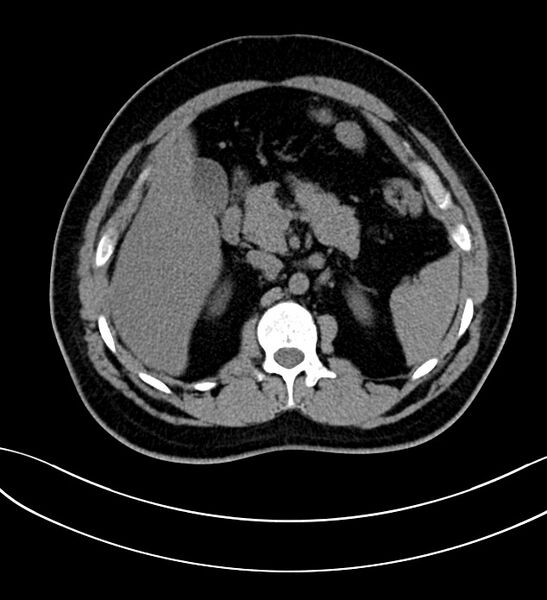 File:Chromophobe renal cell carcinoma (Radiopaedia 84286-99573 Axial non-contrast 15).jpg
