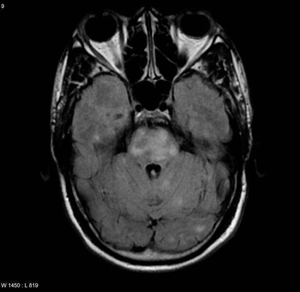 File:Chronic hypertensive encephalopathy (Radiopaedia 4564-6686 Axial FLAIR 2).jpg