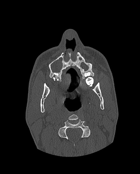 File:Chronic maxillary sinusitis caused by a foreign body (Radiopaedia 58521-65676 Axial bone window 54).jpg