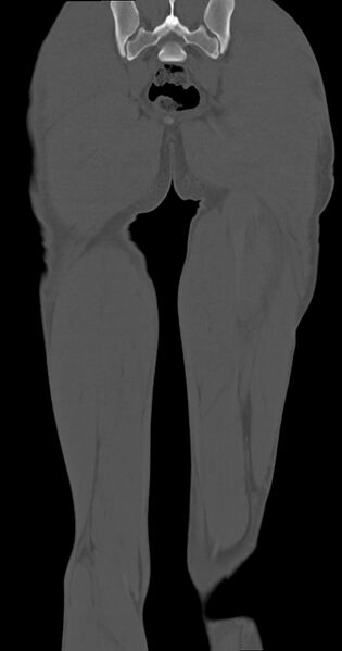 File:Chronic osteomyelitis (with sequestrum) (Radiopaedia 74813-85822 Coronal non-contrast 47).jpg
