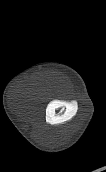 File:Chronic osteomyelitis of the distal humerus (Radiopaedia 78351-90971 Axial bone window 66).jpg