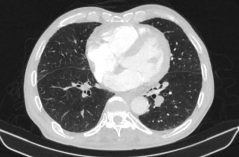 File:Chronic pulmonary embolism (Radiopaedia 91241-108843 Axial lung window 60).jpg