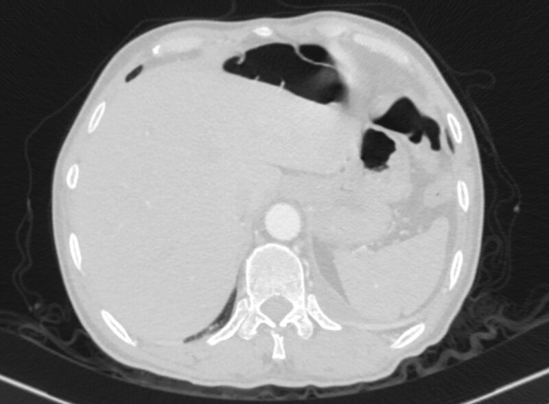 File:Chronic pulmonary embolism with bubbly consolidation (Radiopaedia 91248-108850 Axial lung window 141).jpg