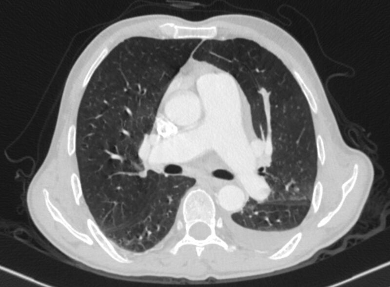 File:Chronic pulmonary embolism with bubbly consolidation (Radiopaedia 91248-108850 Axial lung window 76).jpg