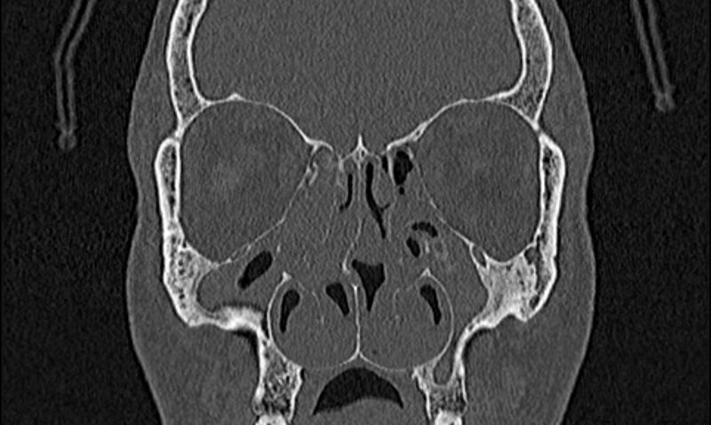 File:Chronic rhinosinusitis (Radiopaedia 65079-74075 Coronal bone window 33).jpg