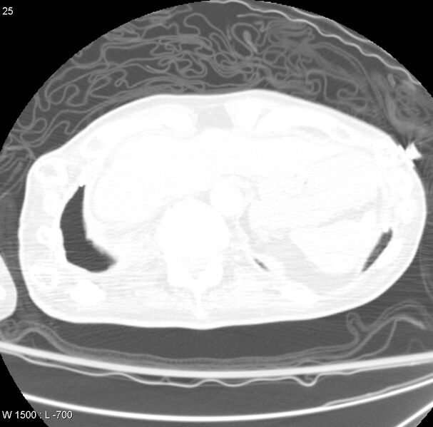 File:Clagett thoracotomy (Radiopaedia 8568-9403 Axial lung window 2).jpg