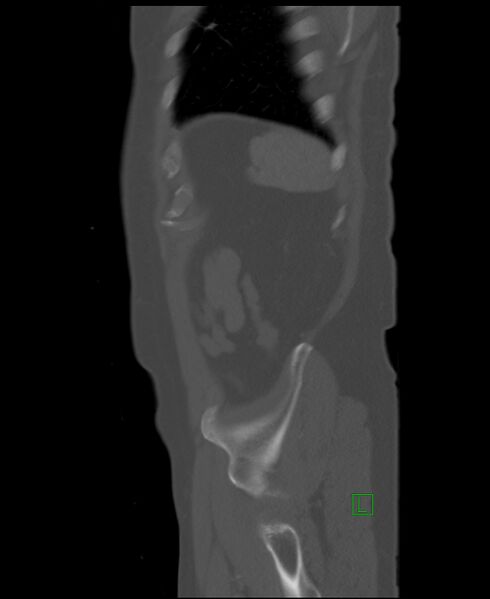 File:Clear cell renal cell carcinoma (Radiopaedia 85006-100539 Sagittal bone window 8).jpg