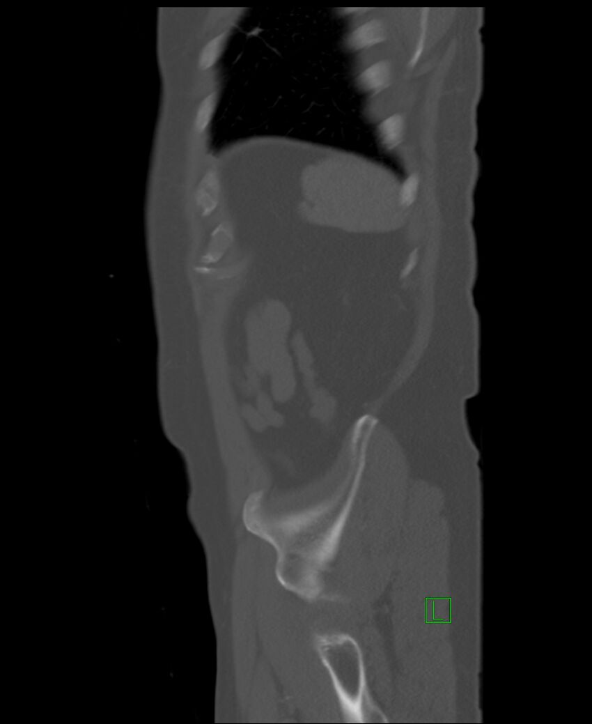Clear cell renal cell carcinoma (Radiopaedia 85006-100539 Sagittal bone window 8).jpg