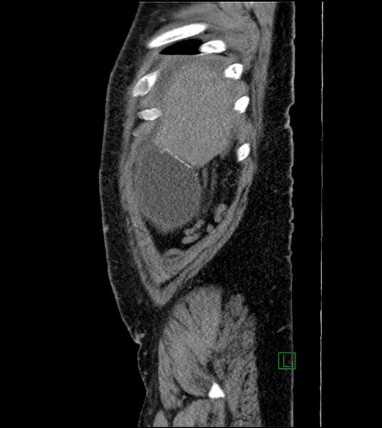 File:Closed-loop small bowel obstruction-internal hernia (Radiopaedia 78439-91096 C 127).jpg