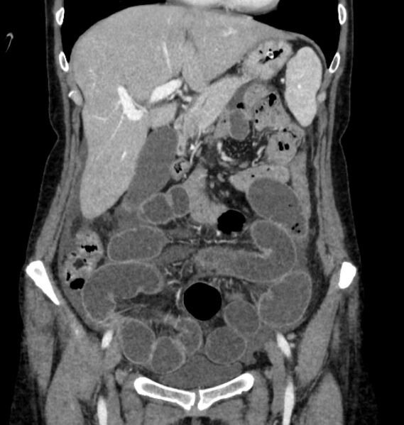 File:Closed loop small bowel obstruction (Radiopaedia 71211-81508 B 33).jpg